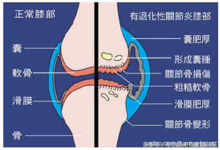 膝关节退行性变和疼痛怎么治疗,膝关节退行性变疼痛的治疗