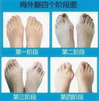 高跟鞋还是少穿吧,许多明星的高颜值,都毁在了一双脚上!