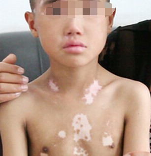 小孩子长了白斑怎么才能治好,声带白斑要注意哪些饮食
