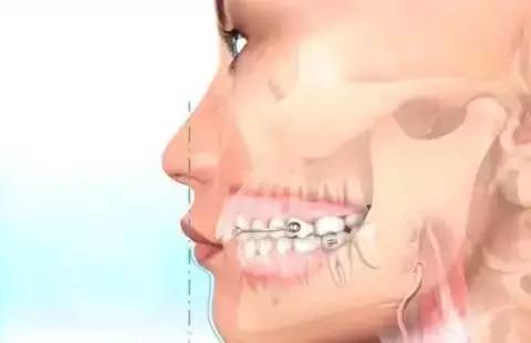如何一秒钟矫正牙齿,牙齿矫正让你悄然改变从现在开始