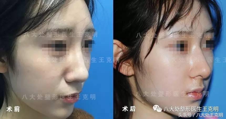 肋软骨隆鼻如何选择合适的形态,肋软骨隆鼻和耳软骨隆鼻哪个安全