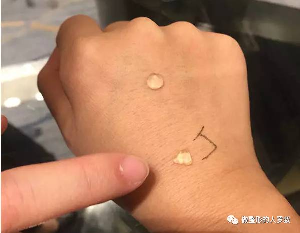 罗叔:10问玻尿酸(建议收藏)