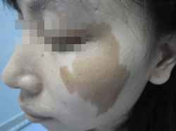 宝宝咖啡斑是晒的吗,宝宝咖啡斑长泡