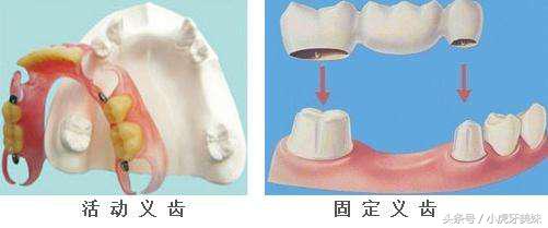 老年人适合的镶牙种类和价格,老年人镶牙选哪种牙比较靠谱