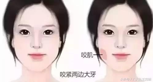 瘦脸针三次真的能定型吗,瘦脸针打三次就可以永久定型了吗