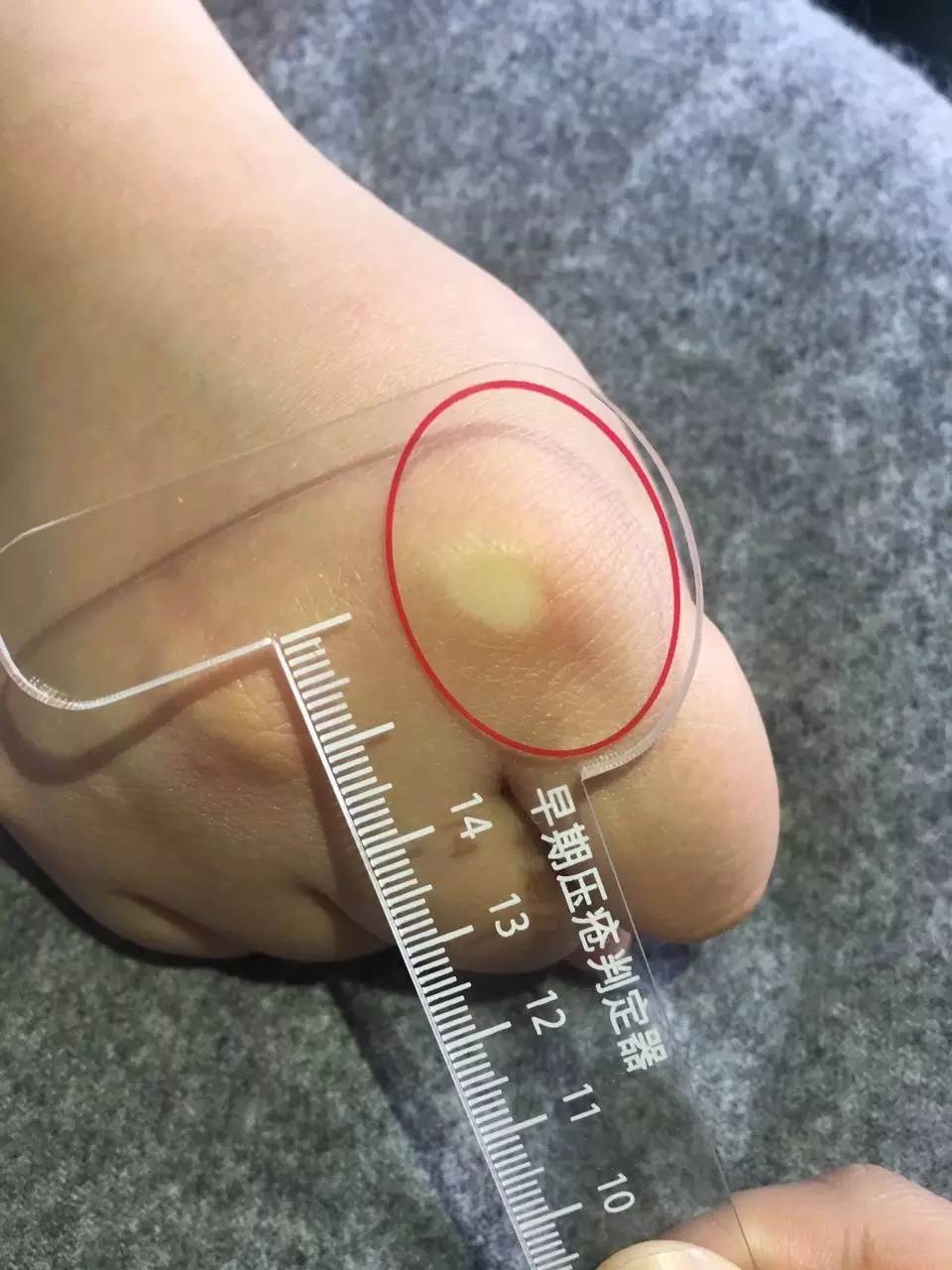 压疮最新指南解读是哪一年的,压疮科普知识