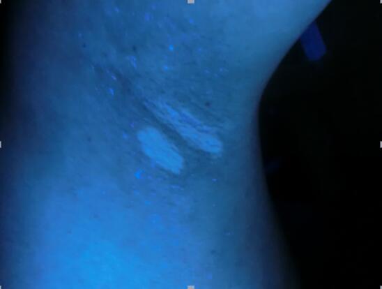 春天预防白癜风加重的方法,当下治疗白癜风最好方法