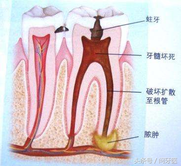 杀牙齿神经的是什么药,牙齿封药杀神经要几天