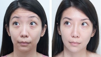 减少脸部皱纹方法教程图片,脸部去除皱纹的最有效的方法动作