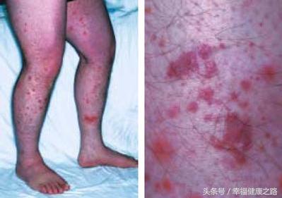 归脾汤治疗过敏性紫癜,得了过敏性紫癜吃归脾丸效果好吗