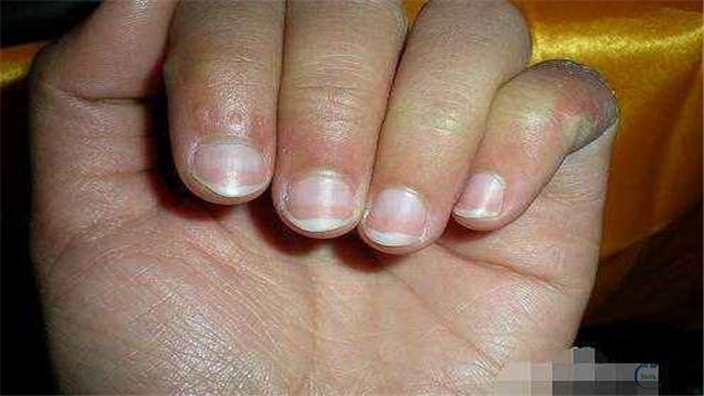 老年人严重贫血表现,若身体出现这3种症状要提高警惕