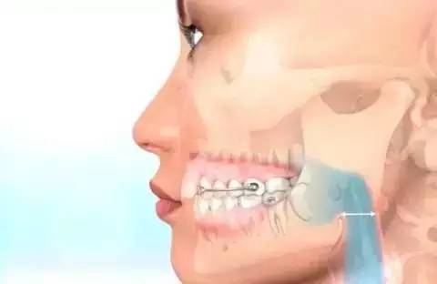 如何一秒钟矫正牙齿,牙齿矫正让你悄然改变从现在开始