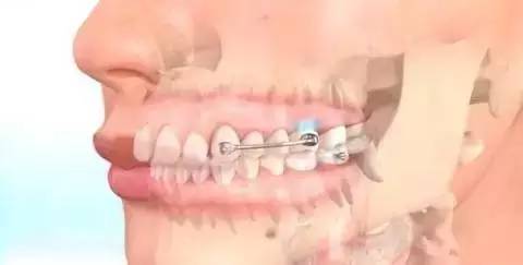 如何一秒钟矫正牙齿,牙齿矫正让你悄然改变从现在开始