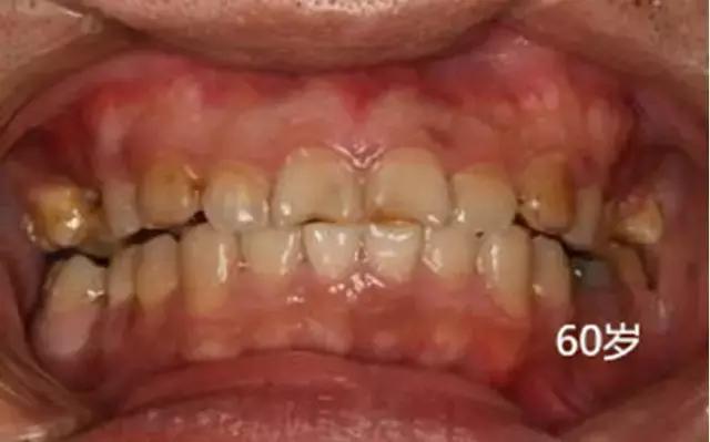 恒牙换牙不,恒牙不长出