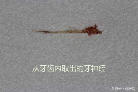 杀牙齿神经的是什么药,牙齿封药杀神经要几天