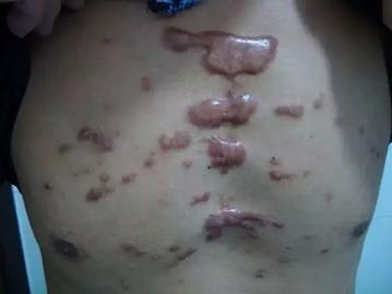 word妈呀!你真的不重视疤痕疙瘩治疗吗?看看这些危害吧