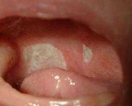 宝宝嘴巴里面有缺口,宝宝嘴巴有一道裂缝