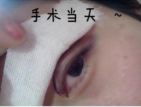 长期用双眼皮胶水变松,长期用胶水粘双眼皮的后果