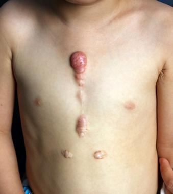 word妈呀!你真的不重视疤痕疙瘩治疗吗?看看这些危害吧