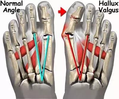 高跟鞋还是少穿吧,许多明星的高颜值,都毁在了一双脚上!