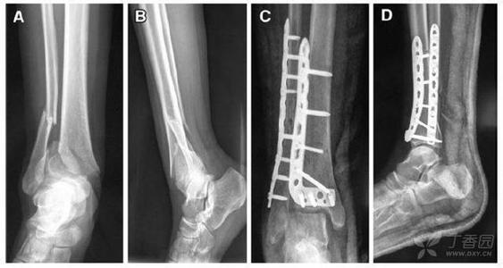 博古特的伤病,博古特扣篮骨折