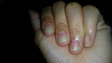 神经性皮炎皮肤变厚变硬皲裂,皮肤增厚皮炎