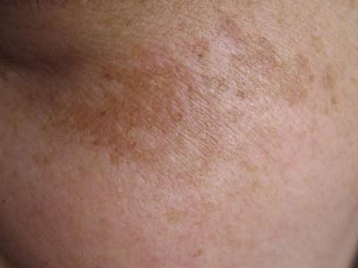 去除脸上斑点最有效的方法,斑点去除最快的方法