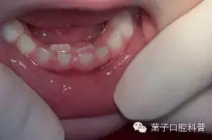 恒牙换牙不,恒牙不长出
