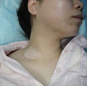 白癜风女生怀孕,吃了治疗白癜风的药怀孕了能要吗