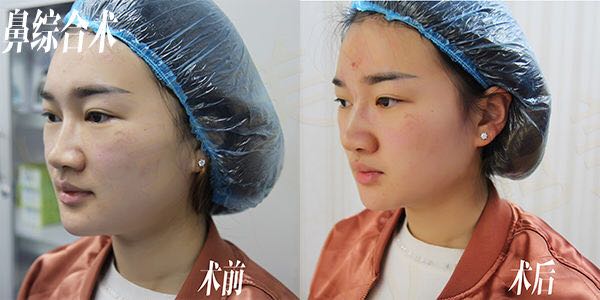 线雕隆鼻多少钱,什么是隆鼻