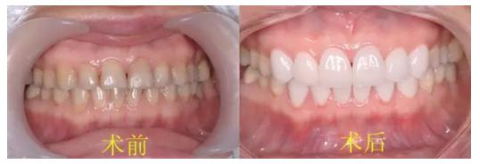 怎么知道牙齿贴面材料真假,牙齿缝隙大适合做贴面还是牙冠