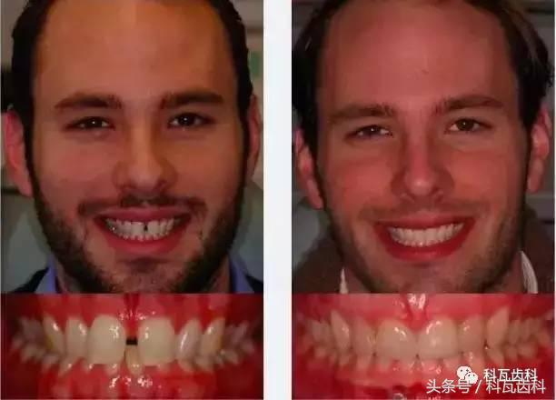 门牙旁边有缝最好的解决方法,门牙缝漏怎么补救