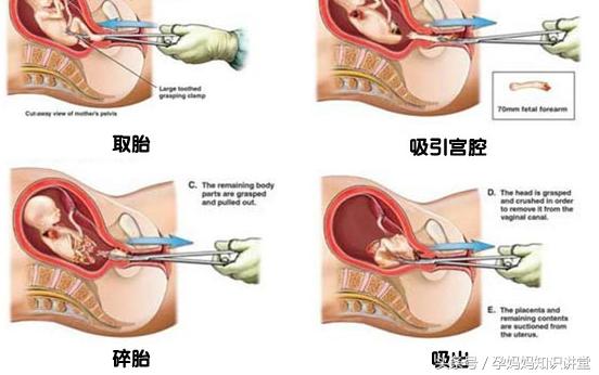 怀孕24周引产后需要怎样调养身体,怀孕28周了孕妇自己注意哪些事项