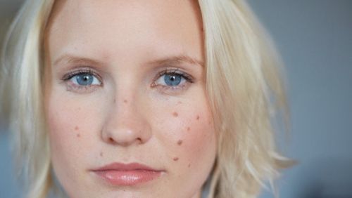 祛痘印真实有效的方法不留痘印,祛痘印的方法怎么可以快速祛痘印