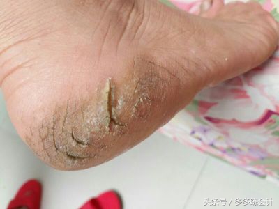夏季脚干裂起硬皮,夏季脚后跟干裂起硬皮怎么办