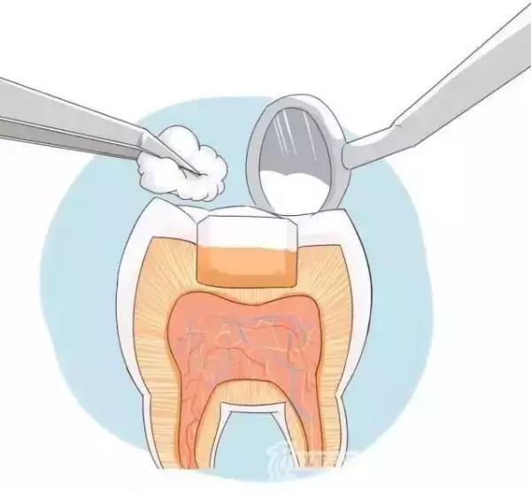 补牙常识,补牙也不知道用的什么材料