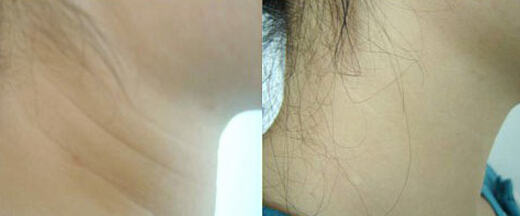 减少脸部皱纹方法教程图片,脸部去除皱纹的最有效的方法动作