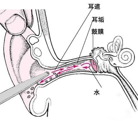 给宝宝洗澡耳朵进水了怎么处理,宝宝耳朵不小心进奶了怎么办