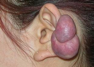 word妈呀!你真的不重视疤痕疙瘩治疗吗?看看这些危害吧