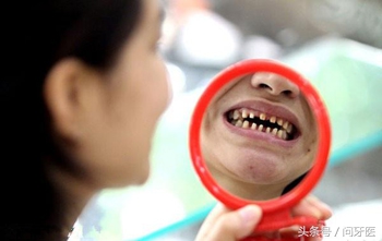 美容冠修复龅牙的利弊,美容冠矫正牙齿怎么样