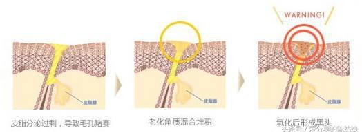 烫伤后毛孔变大会恢复正常吗,毛孔变大了还有没有办法修复