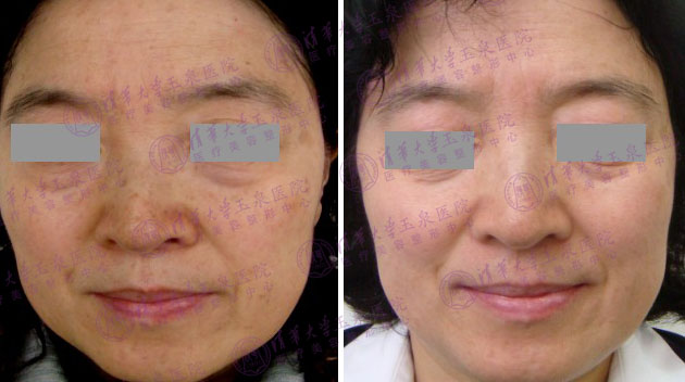 皮肤敏感泛红怎么选择光子嫩肤,油性皮肤怎么推荐光子嫩肤