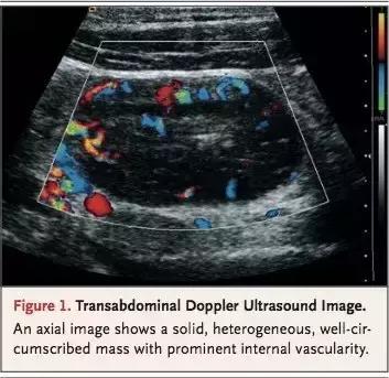 男性右下腹部囊性包块,男性右侧盆腔囊性包块