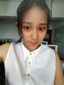 打了一年的水光,打了两年水光针