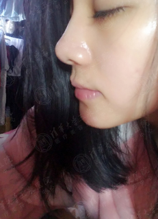 打了一年的水光,打了两年水光针