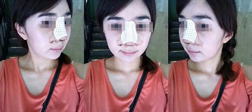 线雕隆鼻多少钱,什么是隆鼻