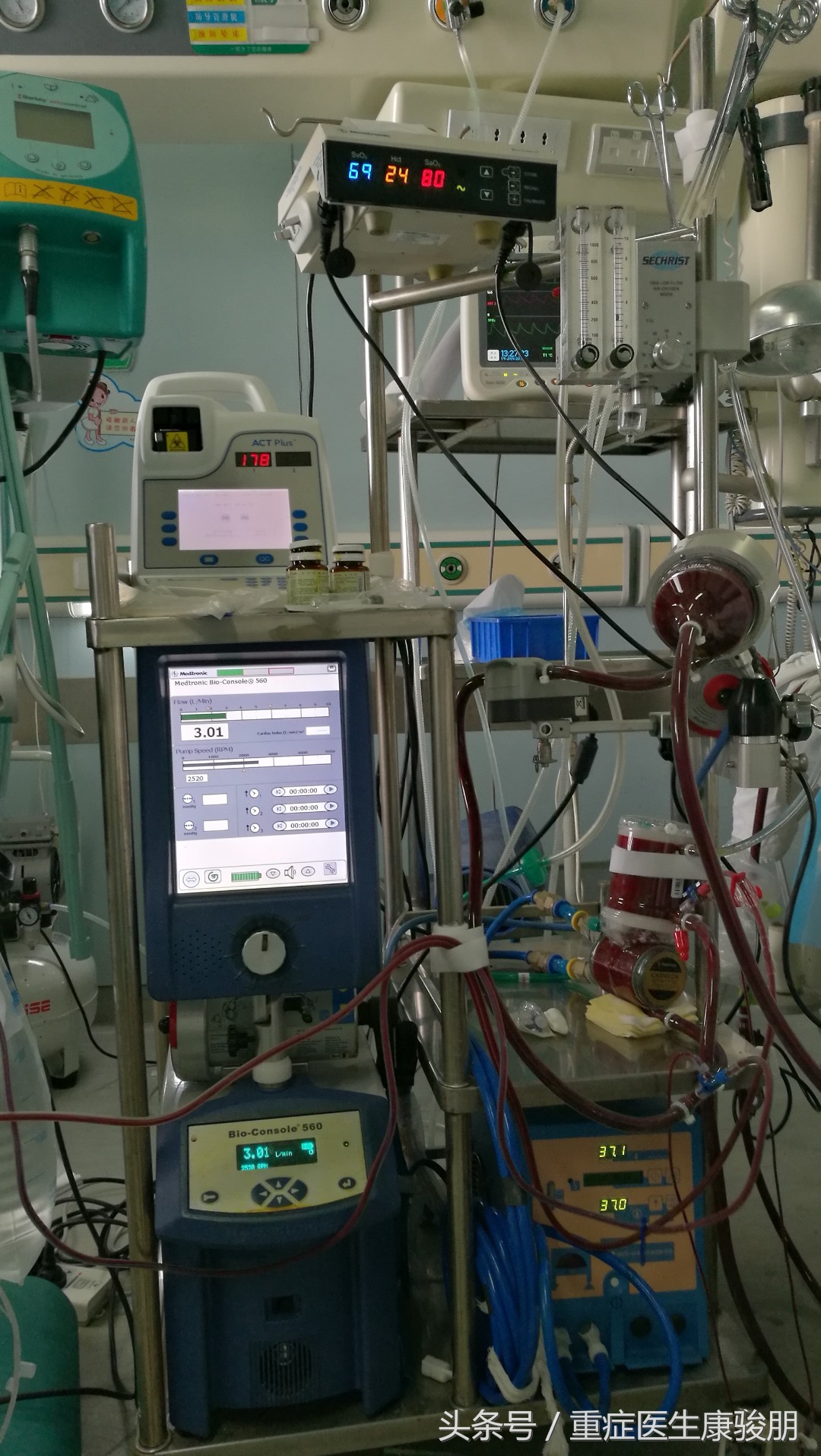 为什么用ecmo有并发症,ecmo相当于哪种急救方法