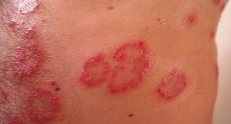 湿疹影响宝宝发育迟缓,肠道湿疹会引起皮肤湿疹吗