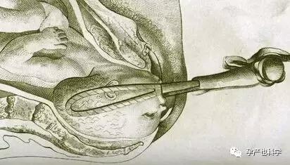 分娩出现这些情况就要产钳助产了！产钳助产风险有哪些？