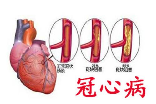 她因冠心病去医院,结果痛经却治好了,这意外收获是咋回事?